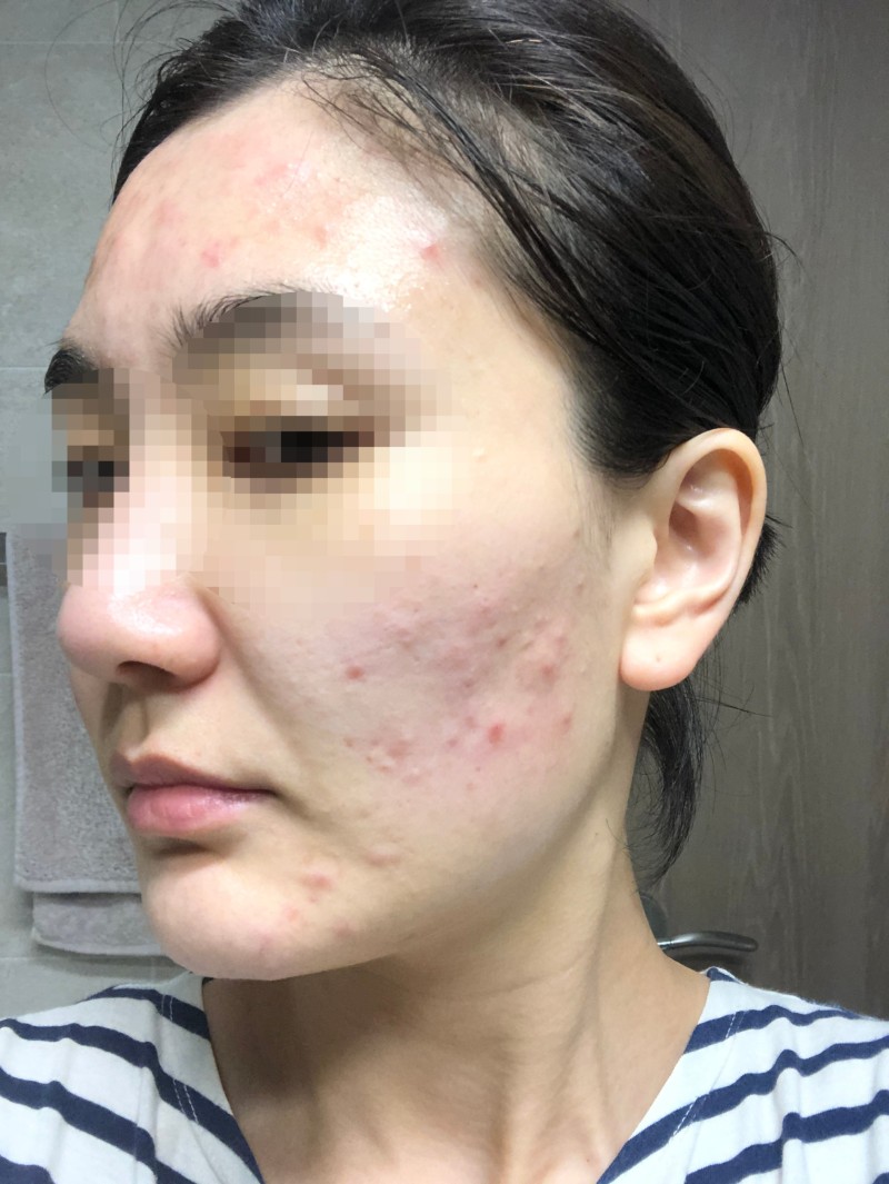 인셀덤 화장품 부작용 울산 남구 피부관리샵 메디뷰제이에서 치료했어요... 내 피부가 살아났다 : 네이버 블로그