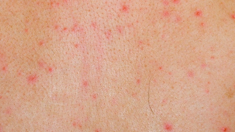 에이즈 초기증상 피부발진 및 원인- Hiv감염 : 네이버 블로그