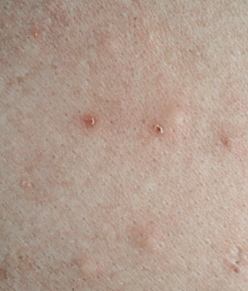 에이즈 피부 증상 : 네이버 블로그